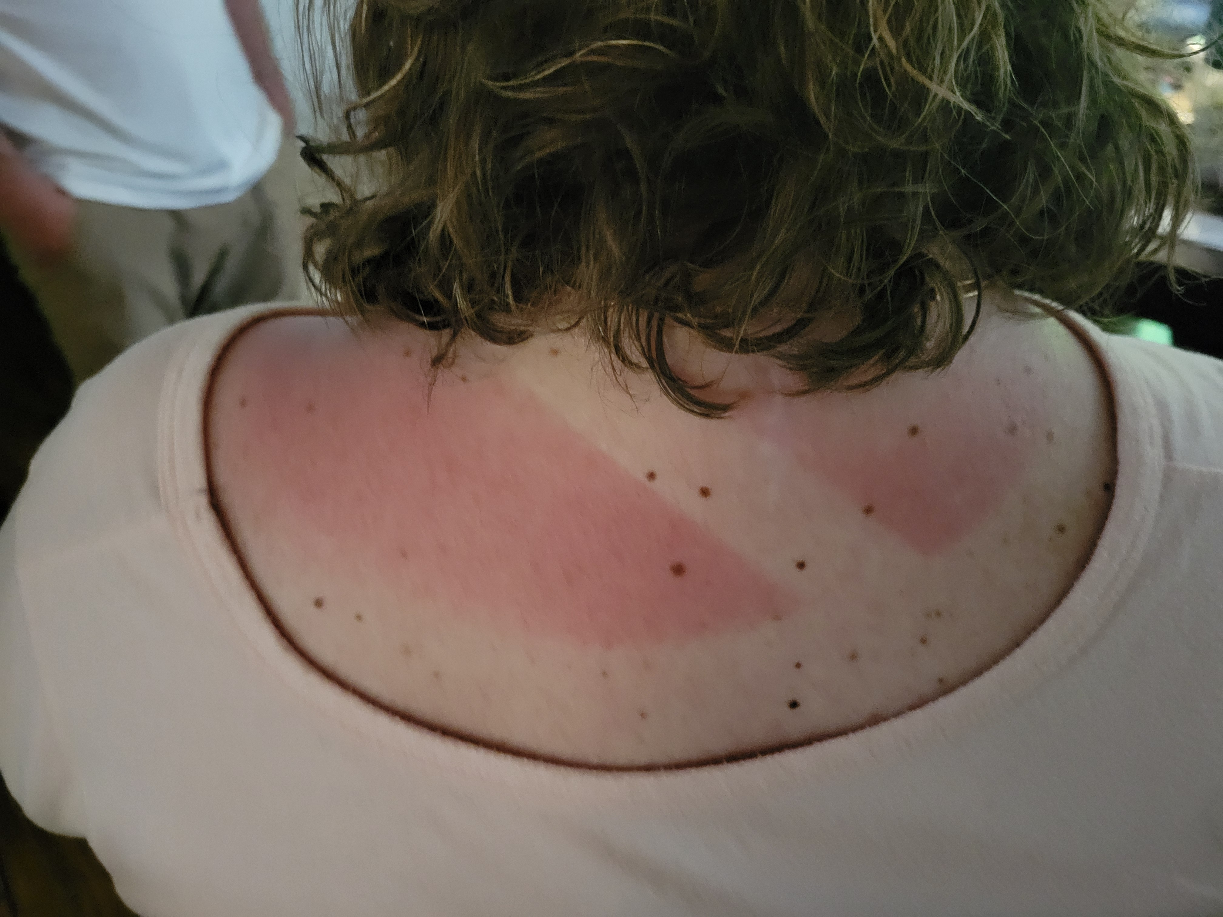 Sunburn! After spending hours under the umbrella,  I spent, maybe 20 minutes on the field watching the girls celebrate.